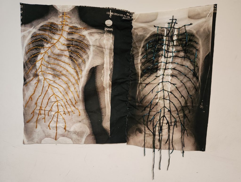 I embroidered my xrays from before and after spinal fusion surgery to show how I experienced permanent nerve damage and pain as a result. On the left side, the viewer can see my severe scoliosis, as I had a 73° curvature before surgery. My nerves on that side are represented by gold thread to symbolize how precious they are. On the right side, the viewer can see my corrected curve and titanium implants. Instead of gold, the nerves on this side are a blackish-turquoise color to show how they have been damaged. Some of the threads are coming out of the fabric to further emphasize the lasting pain caused by the surgery.